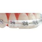 The Morgan Bumper Brace Guard - Clear - Pack of 5